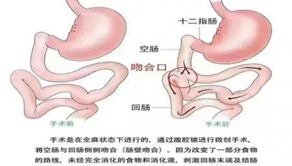 国家卫健委为何禁止这一“糖尿病手术”？