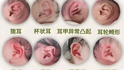 宝宝耳廓形态异常别慌！分清类型+抓住黄金期，轻松搞定“小耳朵”问题