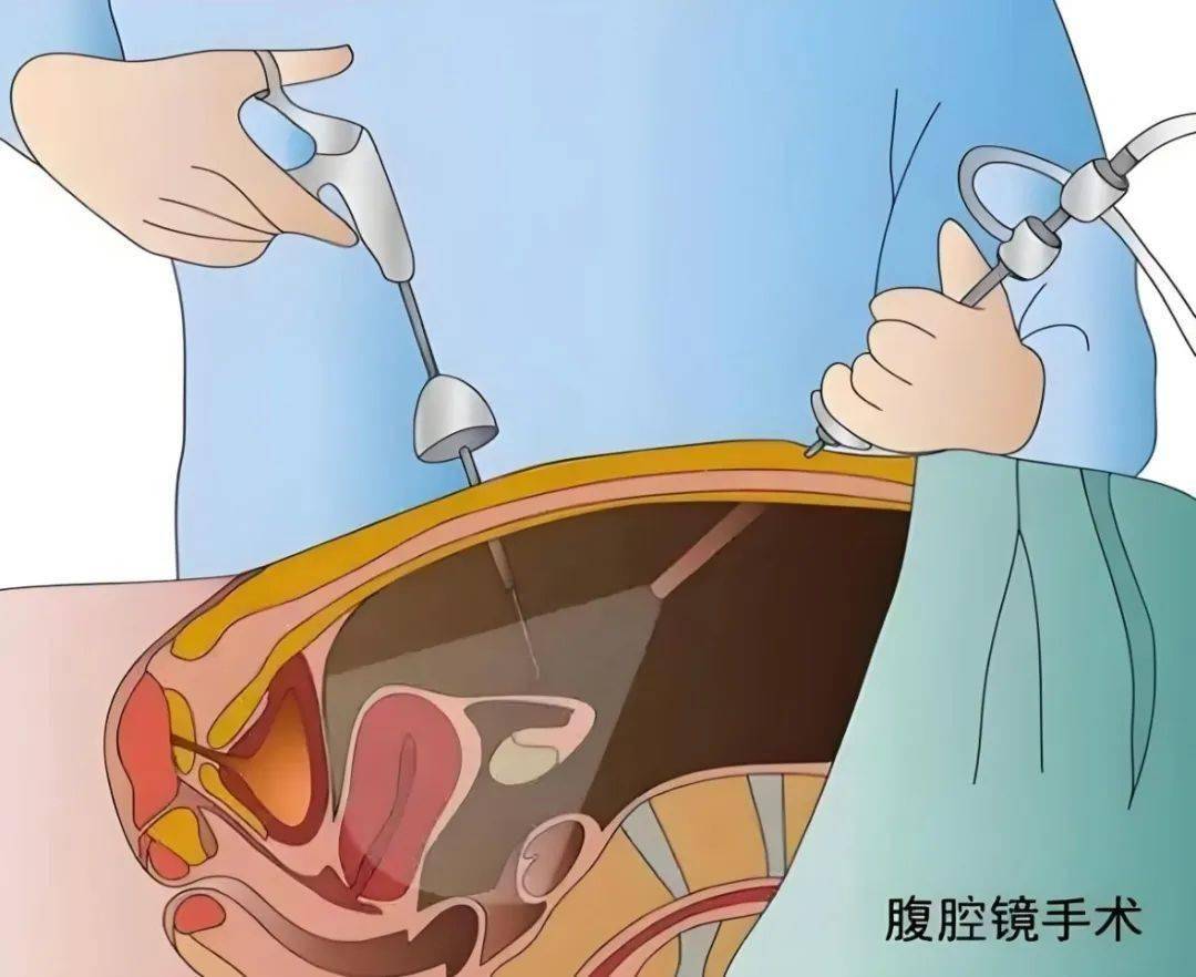 切除子宫哪种方法好？
