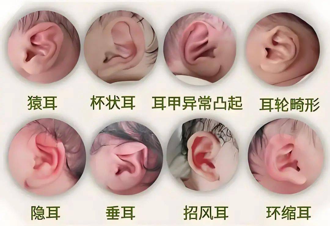 宝宝耳廓形态异常别慌！分清类型+抓住黄金期，轻松搞定“小耳朵”问题